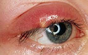 Bệnh viêm bờ mi là tình trạng bờ mi mắt bị viêm, xuất hiện các hiện tượng: ngứa, bỏng rát, đỏ và phù. Bệnh gây khó chịu nhiều cho người bệnh, làm mất tập trung, suy giảm tầm nhìn. Bệnh viêm bờ mi thường gặp ở cả hai mắt. 